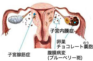 現代女性に増えている子宮内膜症 横浜市都筑区の婦人科 ひまわりレディースクリニック